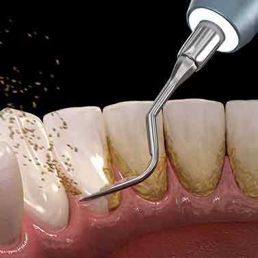 a computer illustration depicting the back side of teeth being cleaned